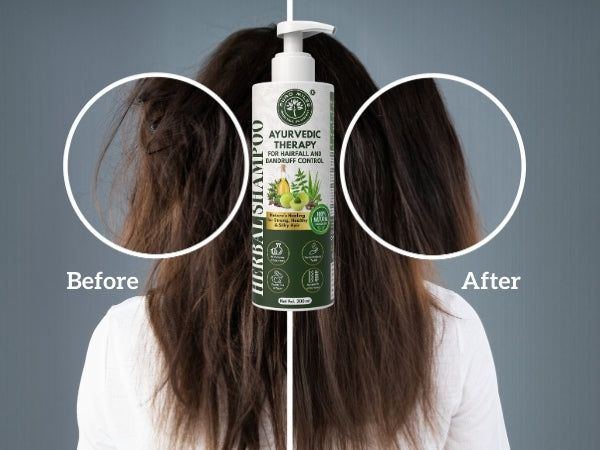 Ayurvedic Shampoo for Hair Fall and Dandruff Control